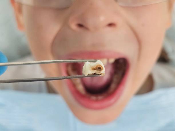 Best Emergency Treatment for Dental Infections or Abscesses in Alpine, TX